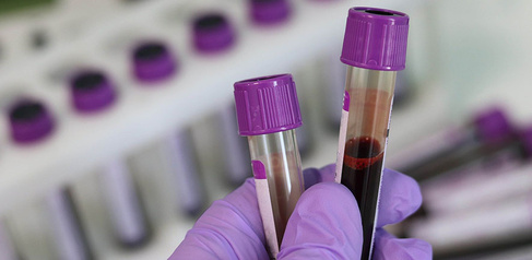 Blood samples in tubes